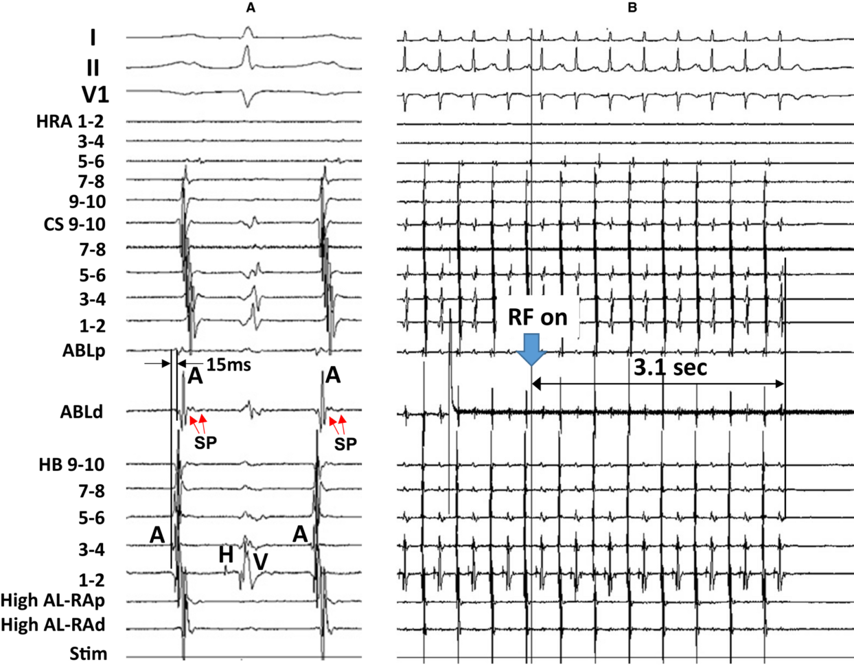 Slow Potential At The Entrance Of The Slow Conduction Zone In The