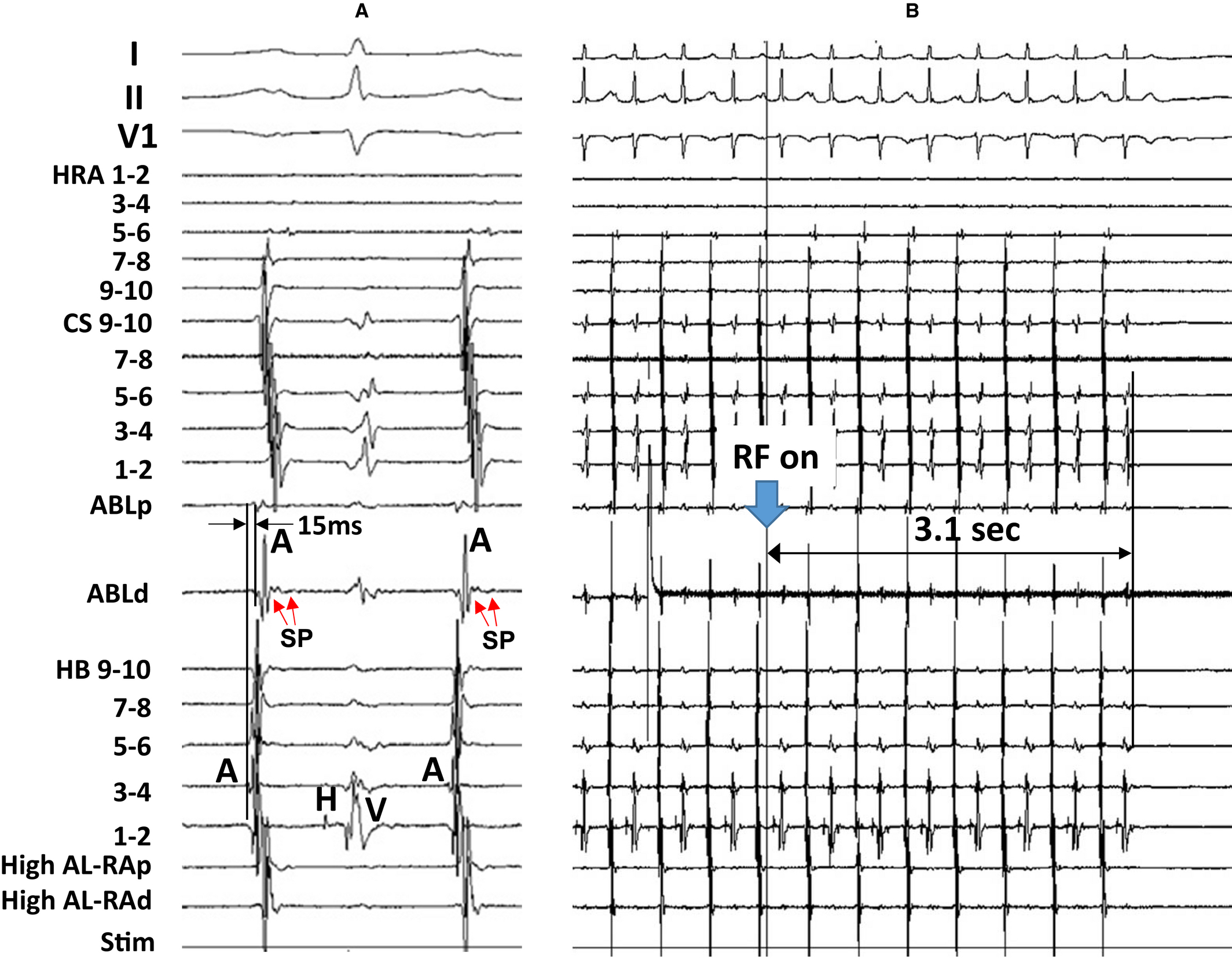 Slow Potential At The Entrance Of The Slow Conduction Zone In The