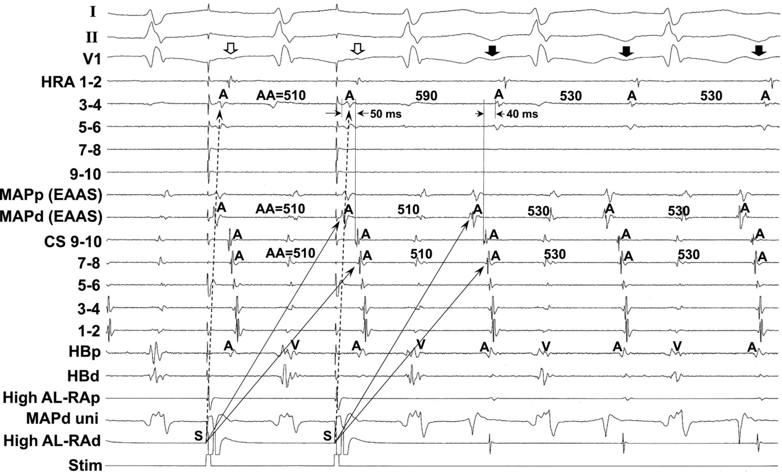 Slow Potential At The Entrance Of The Slow Conduction Zone In The